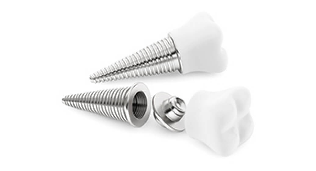 Implantate - Zahnarzt in Buchholz