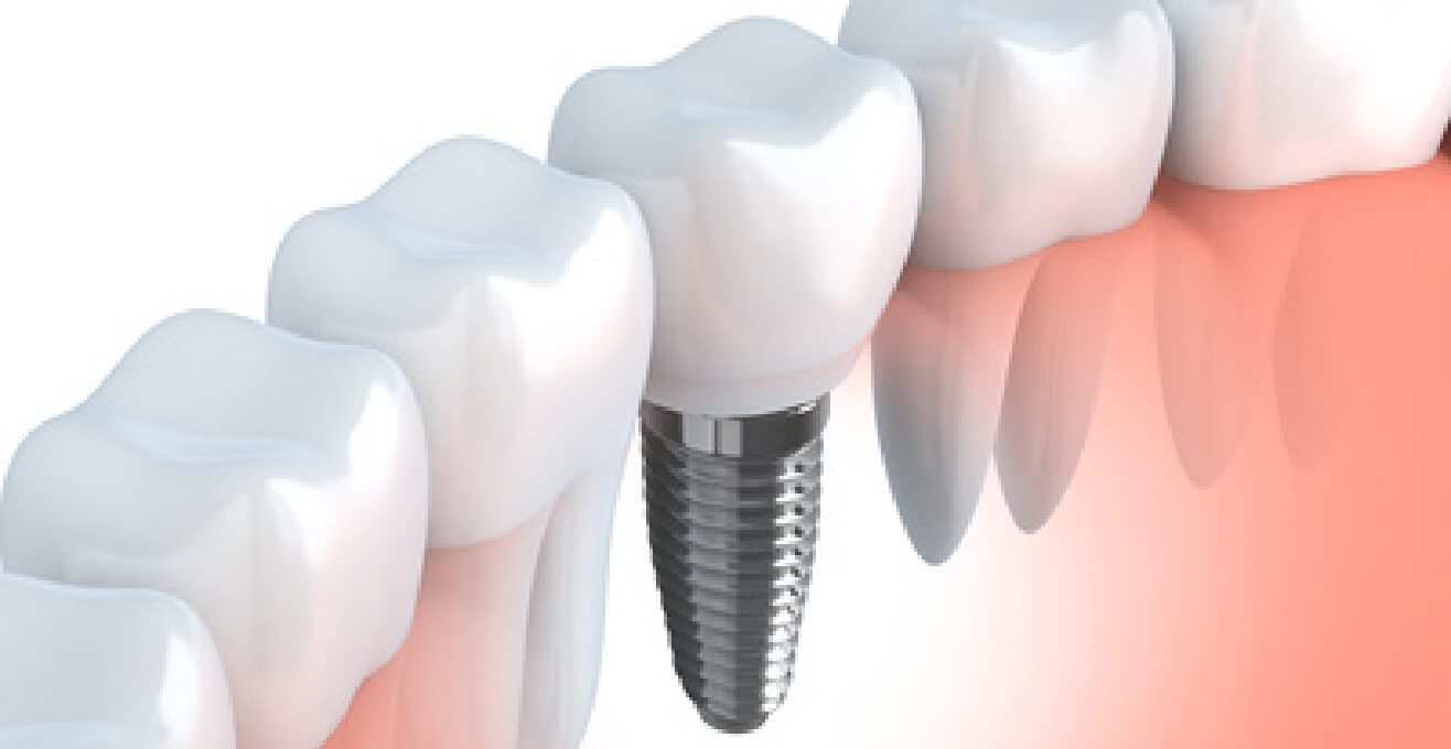 Zahn Implantate